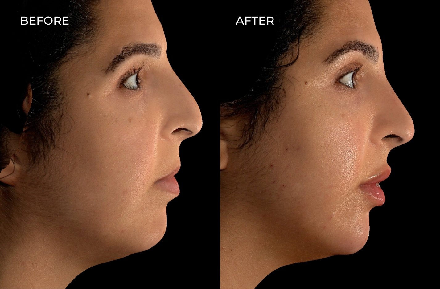 Before and after lip fillers in San Diego